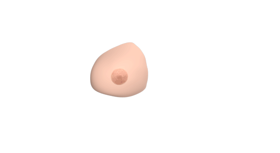 3D view of the custom breast prosthesis