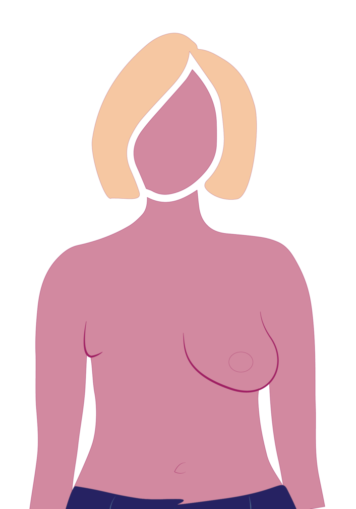 Mastectomy surgery type 8
